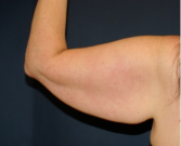 Feel Beautiful - Arm Reduction 211 - Before Photo